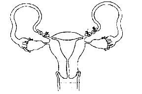 AIPMT 2012 Prelims Biology - Reproductive Health Question 42 English